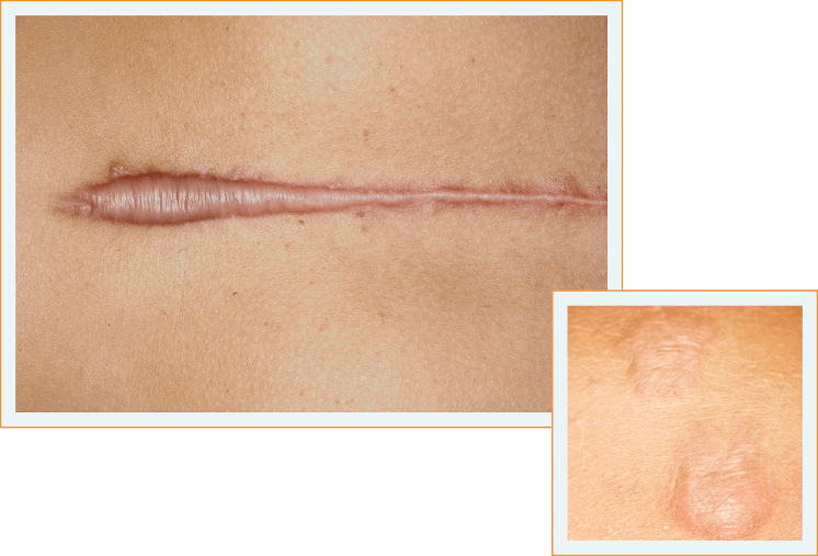 Dermatix Gel clinically proven, visible scar reduction treatment